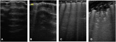 Lung ultrasound supports clinical evaluation of feeding competence development in preterm neonates